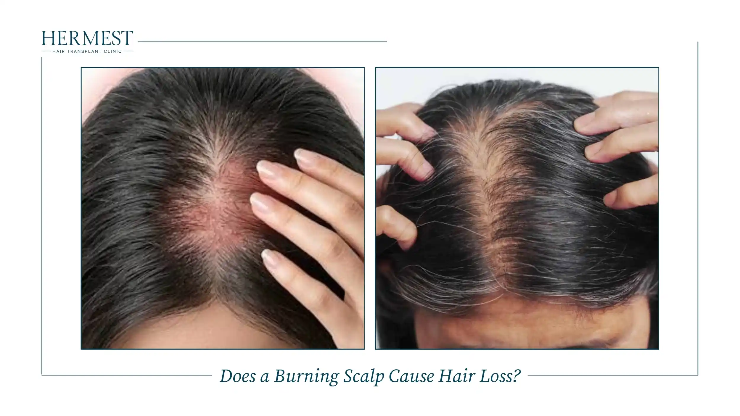 Does a Burning Scalp Cause Hair Loss