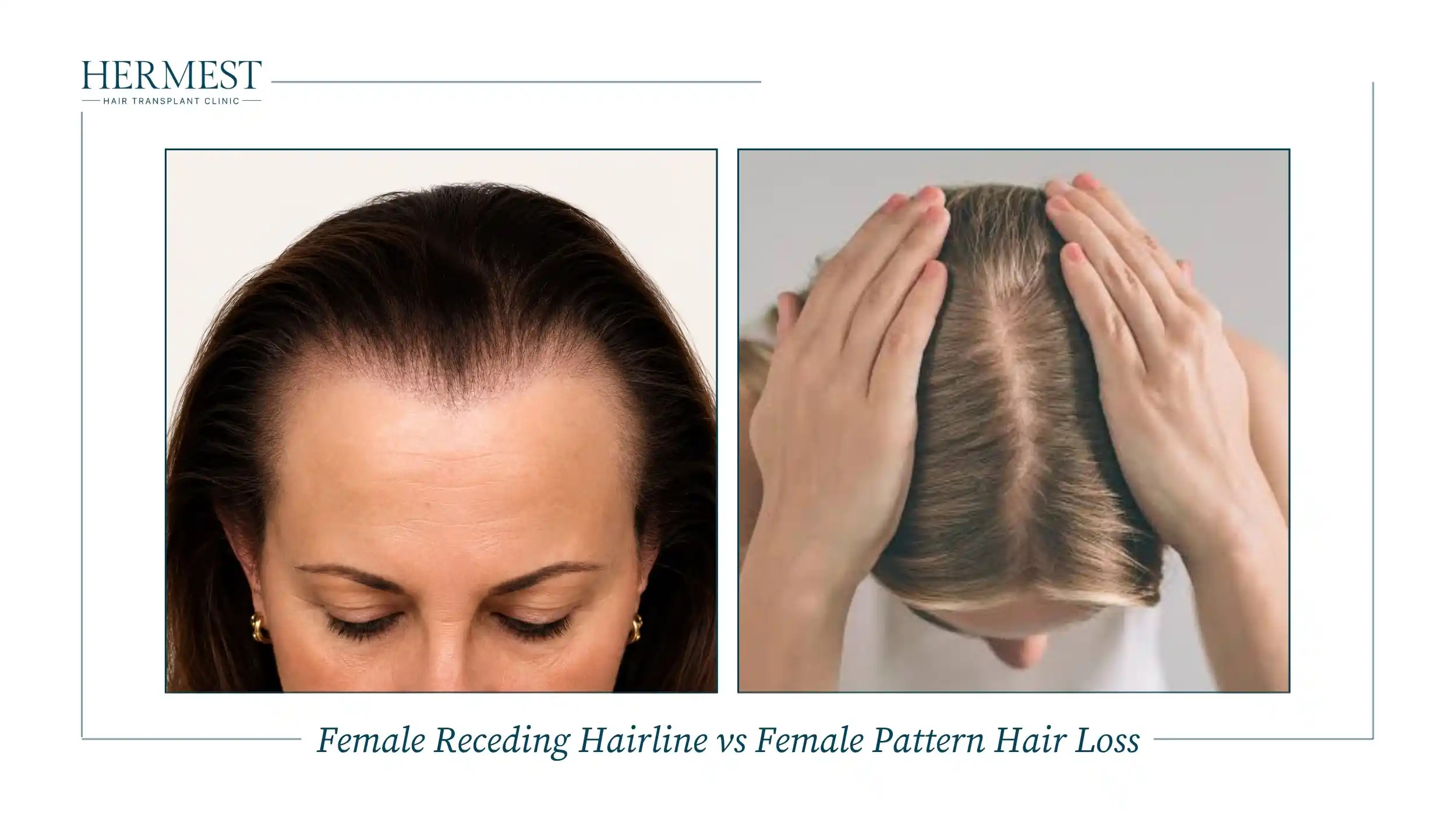 Female Receding Hairline vs Female Pattern Hair Loss
