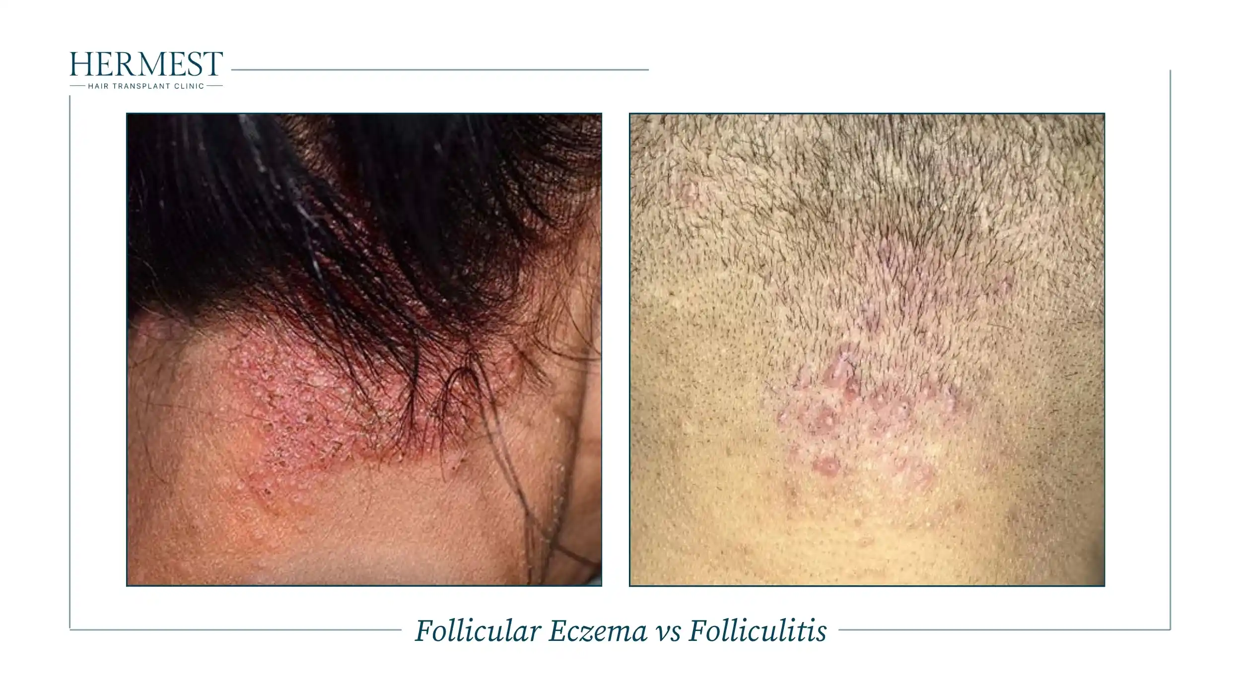 Follicular Eczema vs Folliculitis