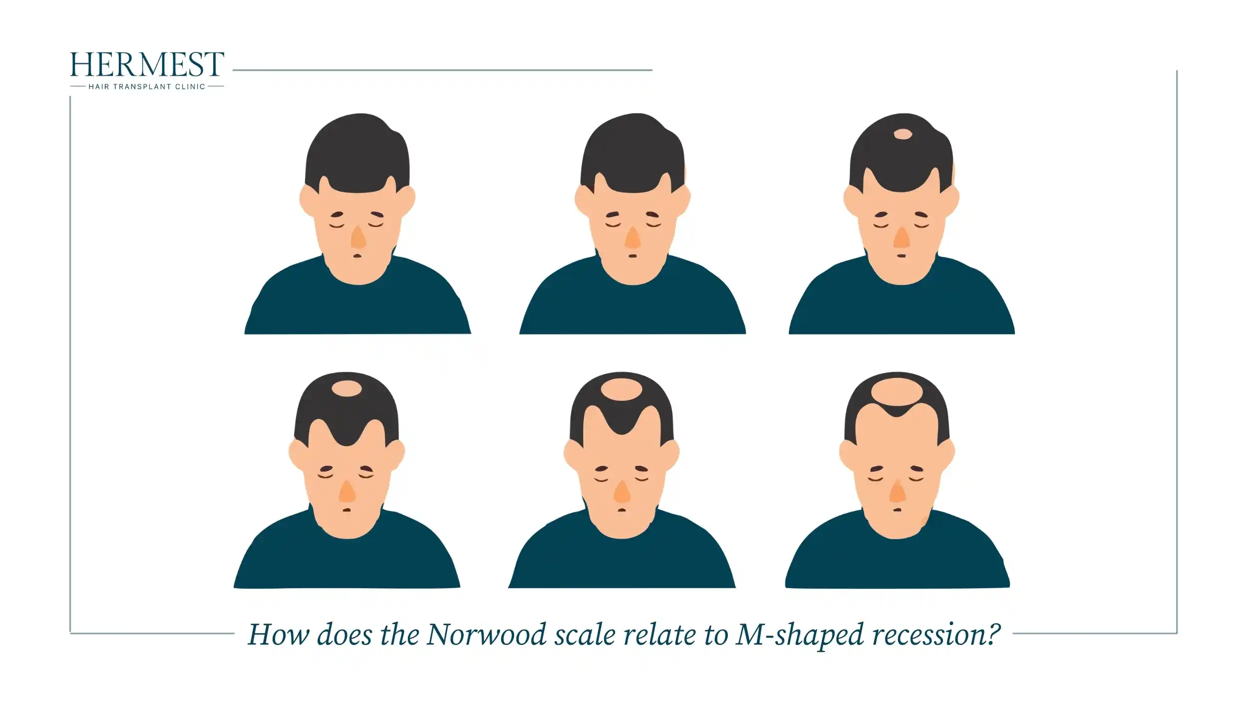 Illustration of six Norwood scale stages showing M-shaped recession progressing to crown balding