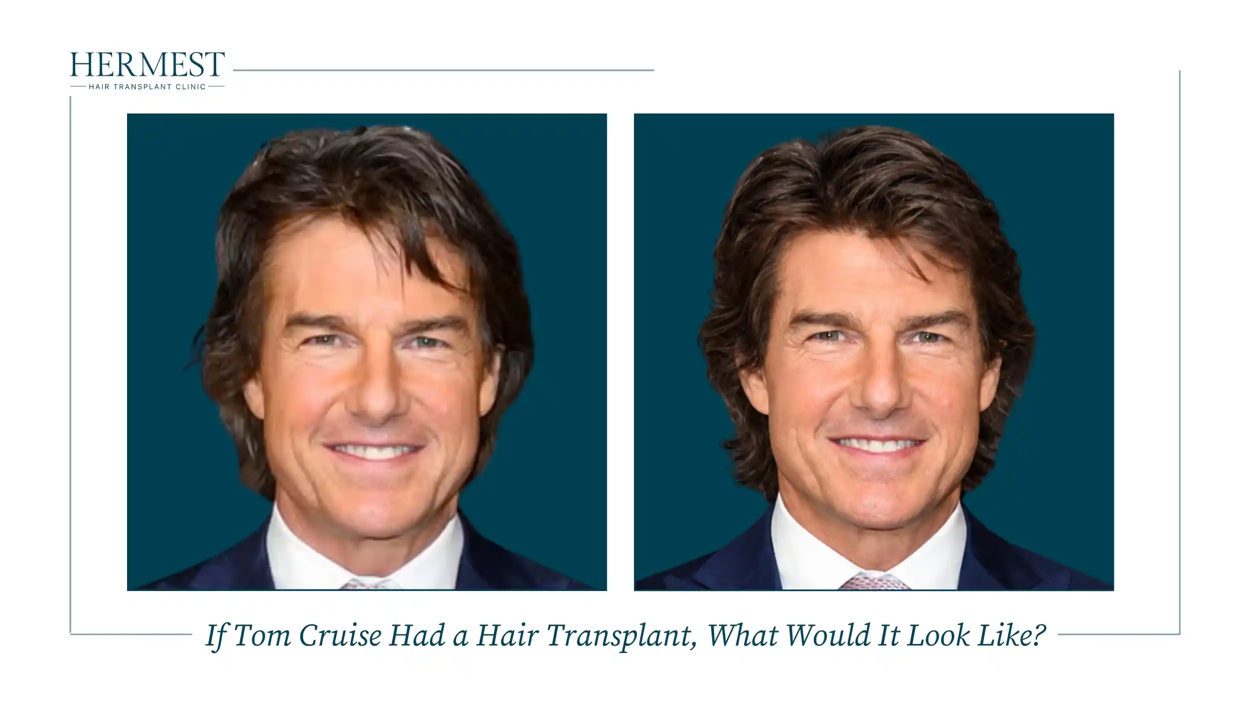 If Tom Cruise Had a Hair Transplant, What Would It Look Like