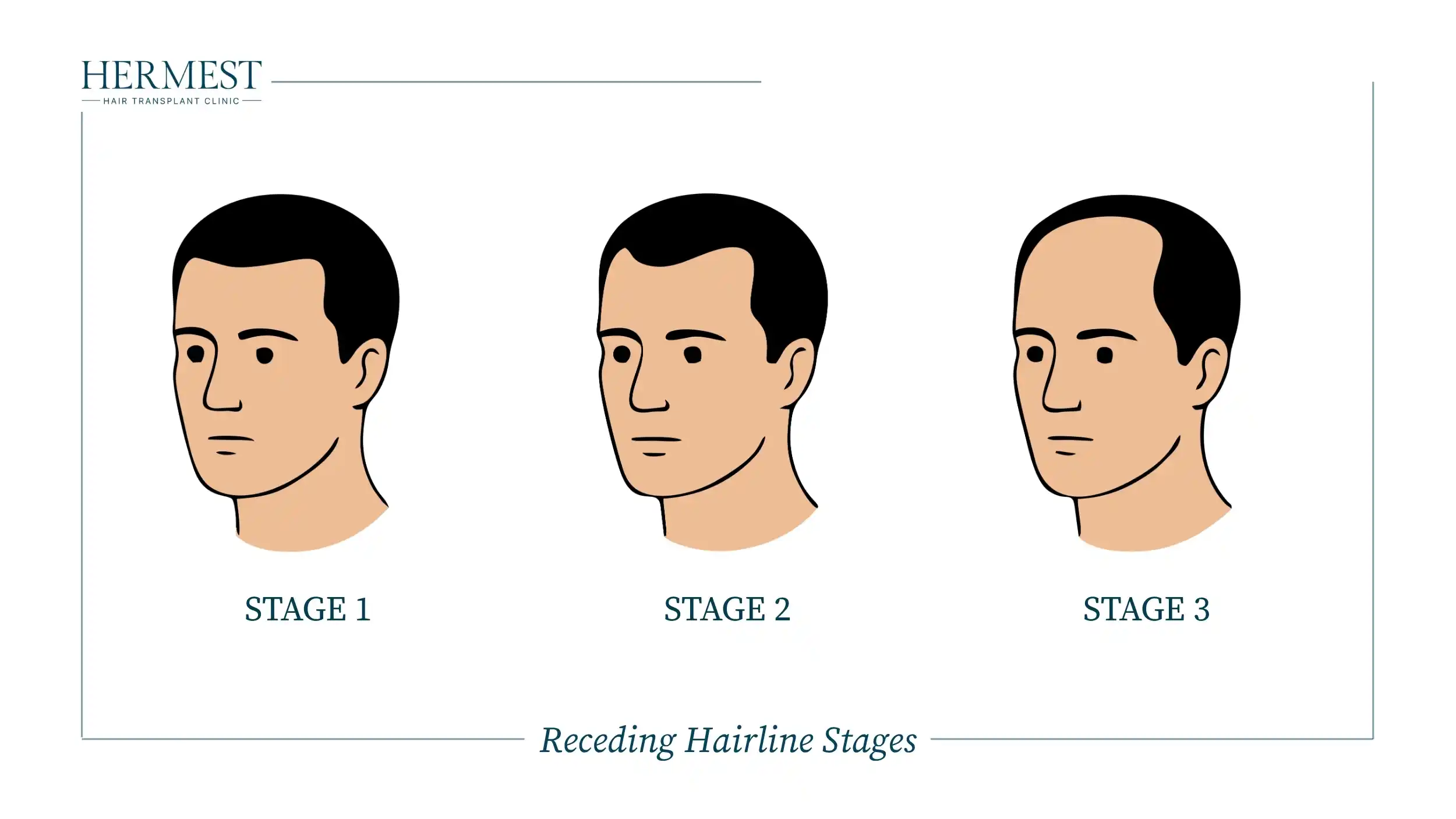 Receding Hairline Stages