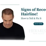 Signs of Receding Hairline