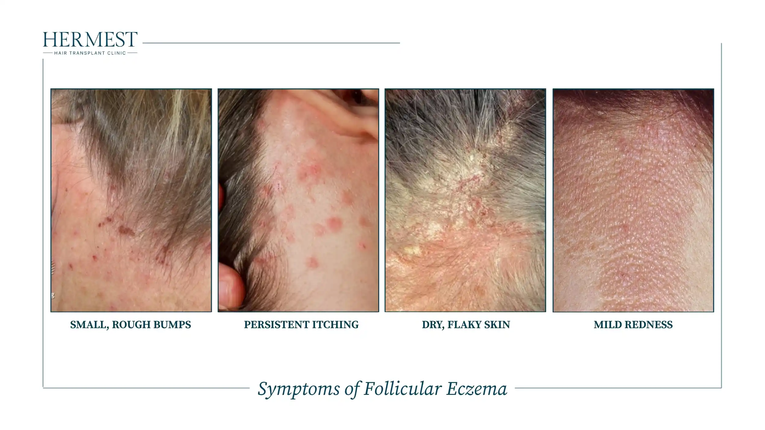 Symptoms of Follicular Eczema