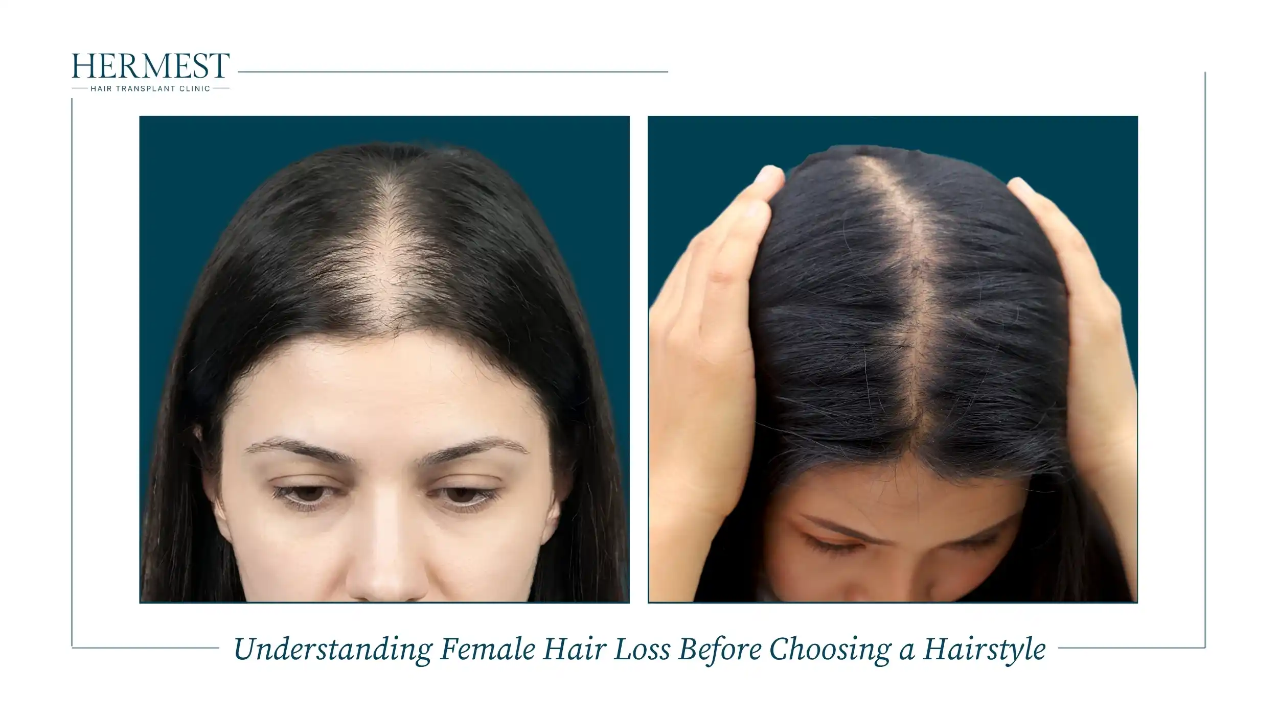 Understanding Female Hair Loss Before Choosing a Hairstyle