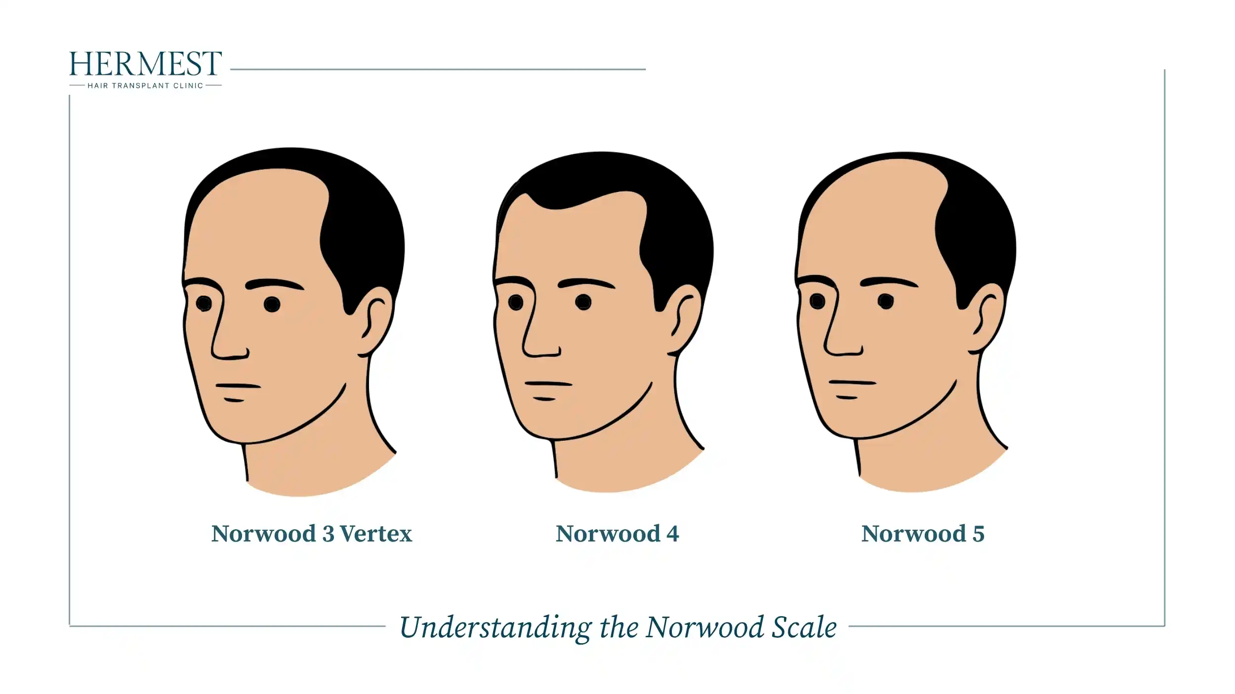 Understanding the Norwood Scale