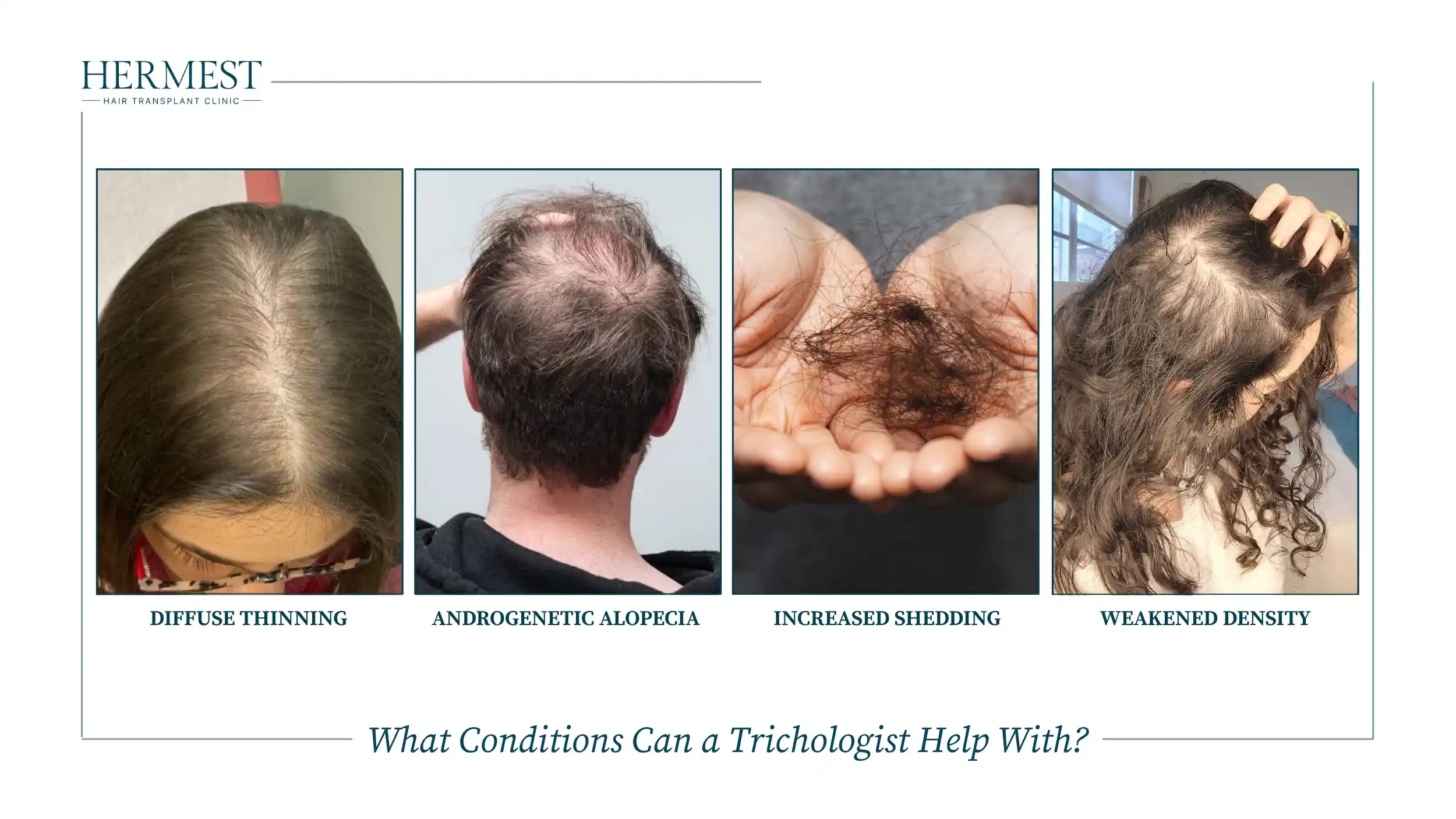 Diffuse thinning, androgenetic alopecia, increased shedding and weakened density: conditions a trichologist treats
