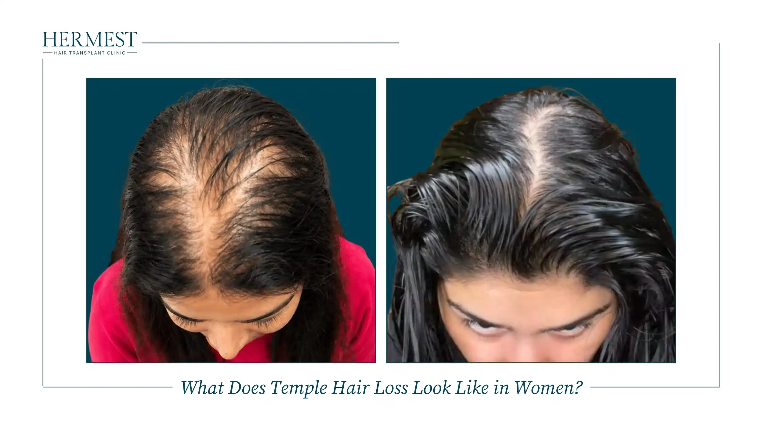 What Does Temple Hair Loss Look Like in Women