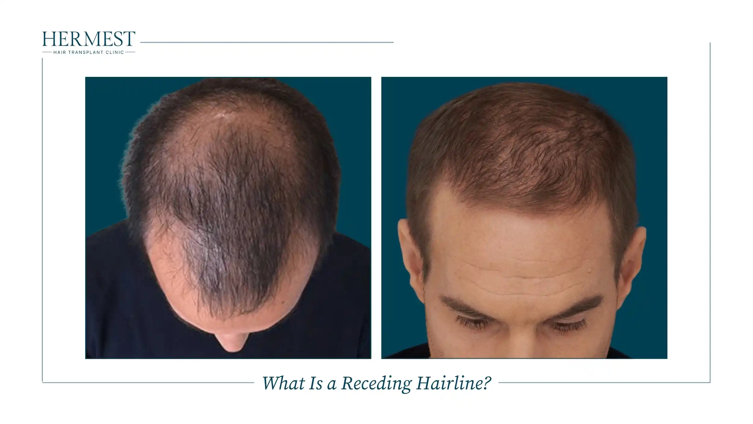 What Is a Receding Hairline