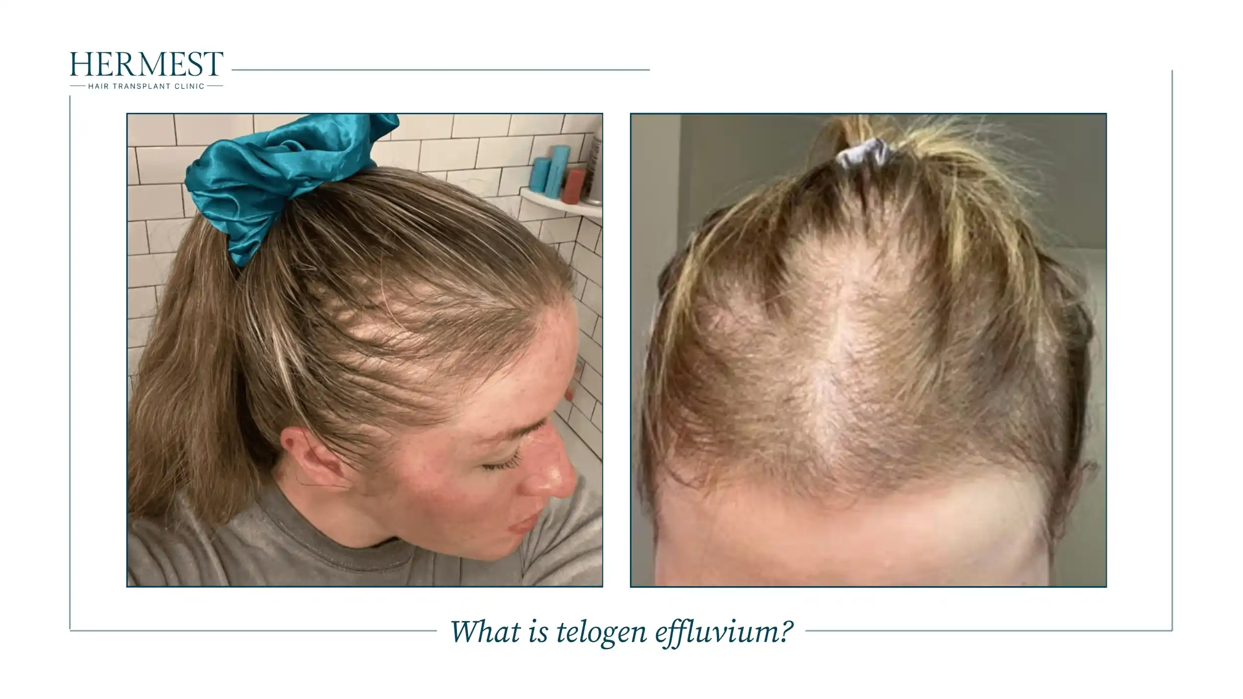 Woman with diffuse thinning at the front and top of the scalp, typical of telogen effluvium hair shedding