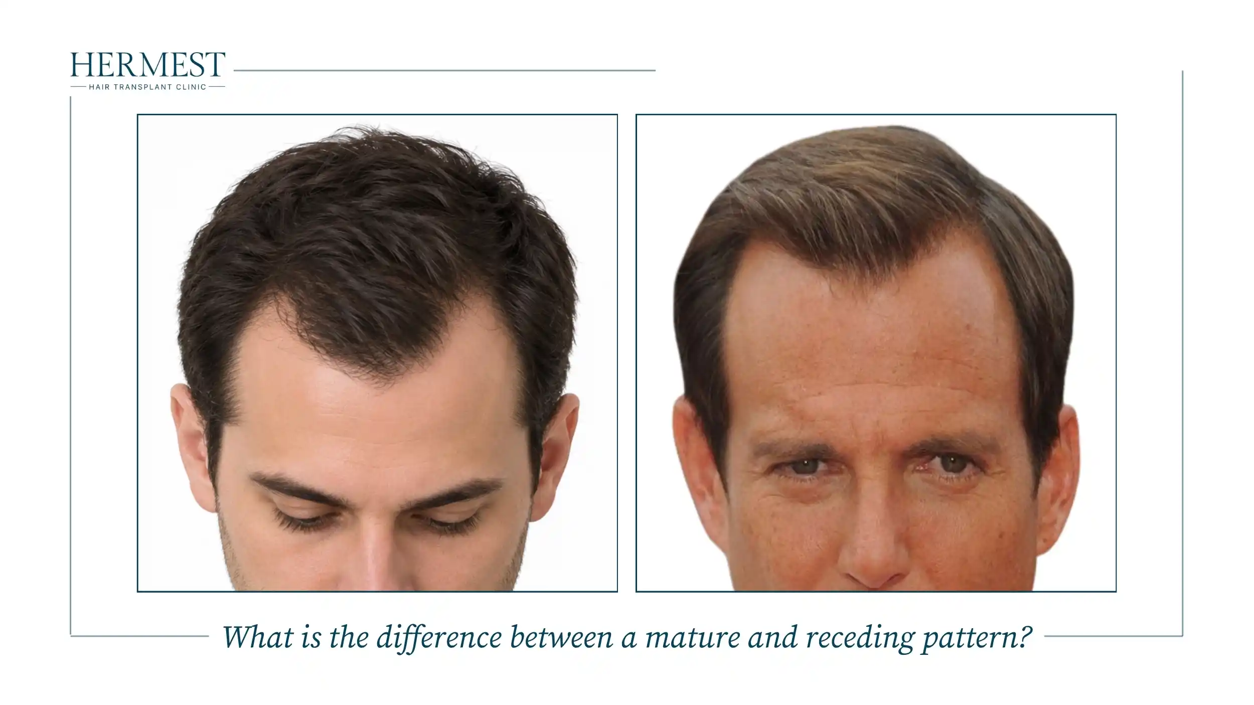 Mature hairline with slight temple recession compared with a clearly receding hairline in another man