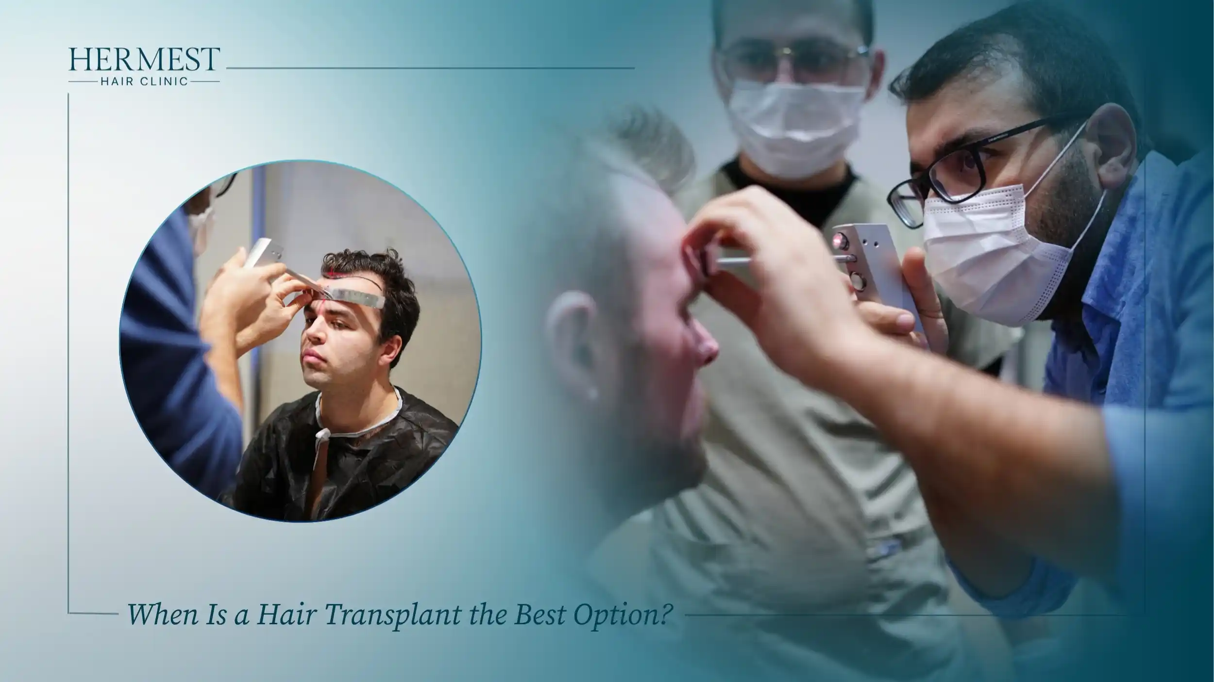 When Is a Hair Transplant the Best Option