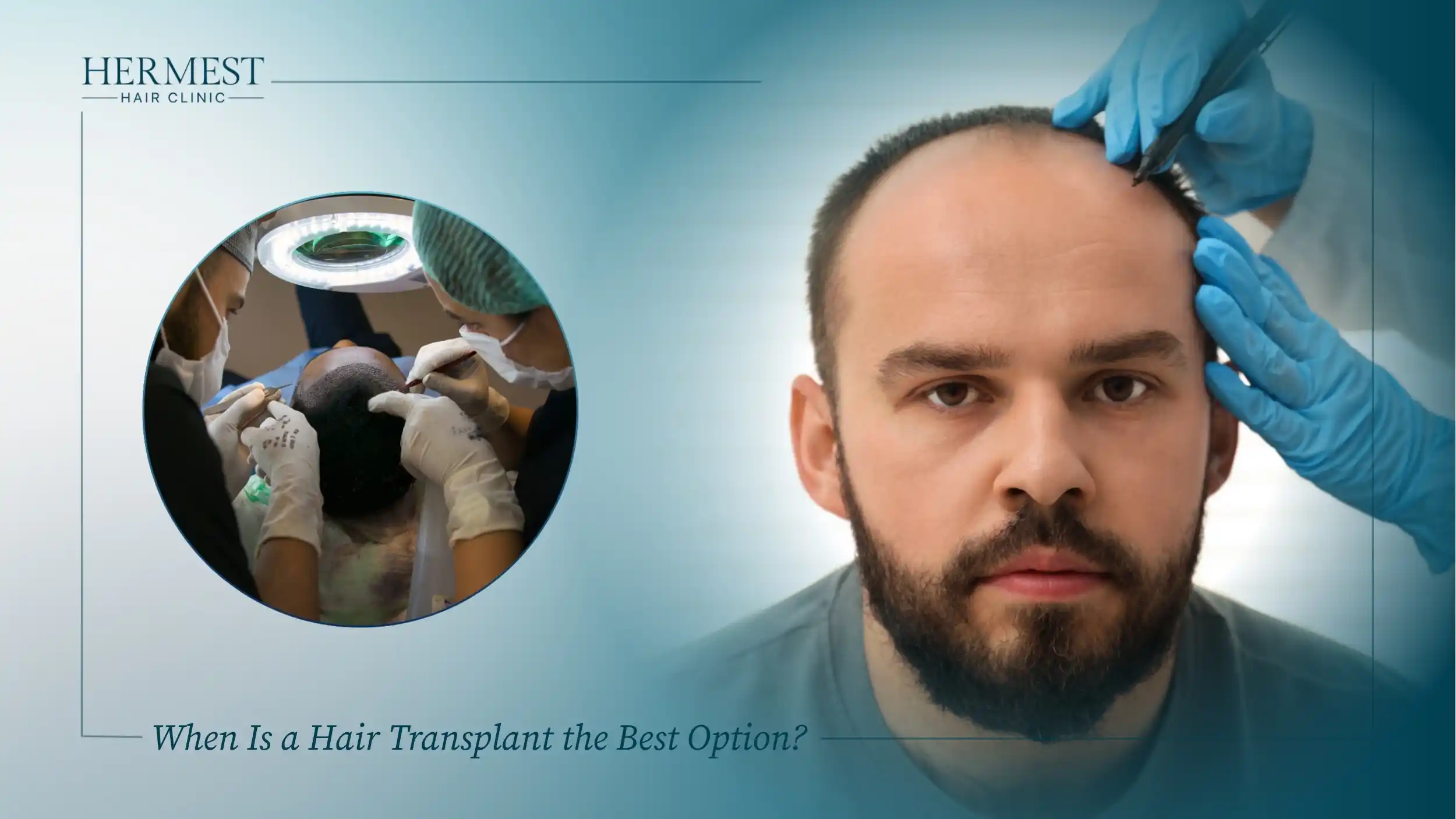 When Is a Hair Transplant the Best Option