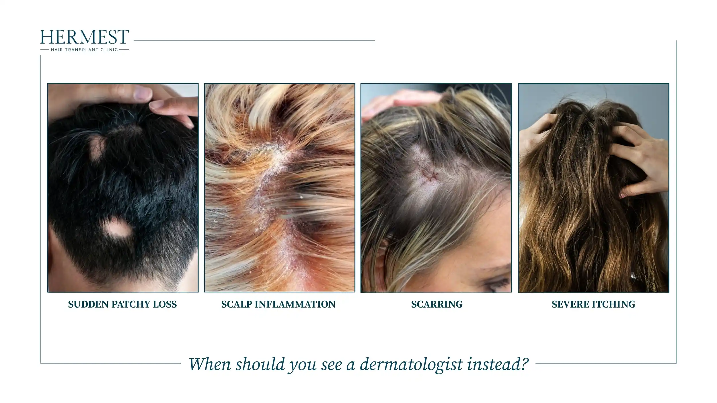 Four scalp problems needing a dermatologist: sudden patchy hair loss, scalp inflammation, scarring and severe itching