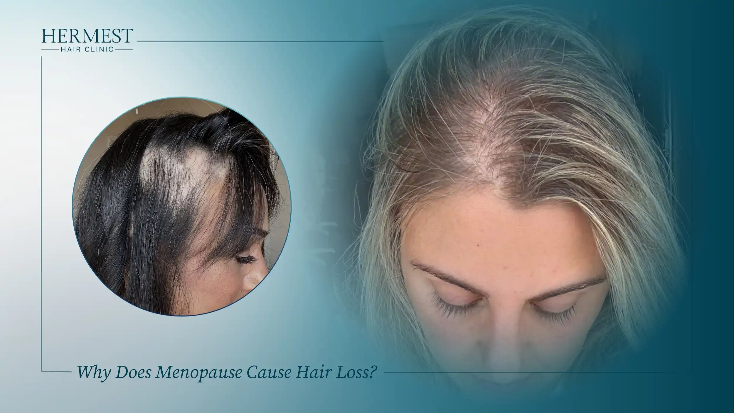 Why Does Menopause Cause Hair Loss