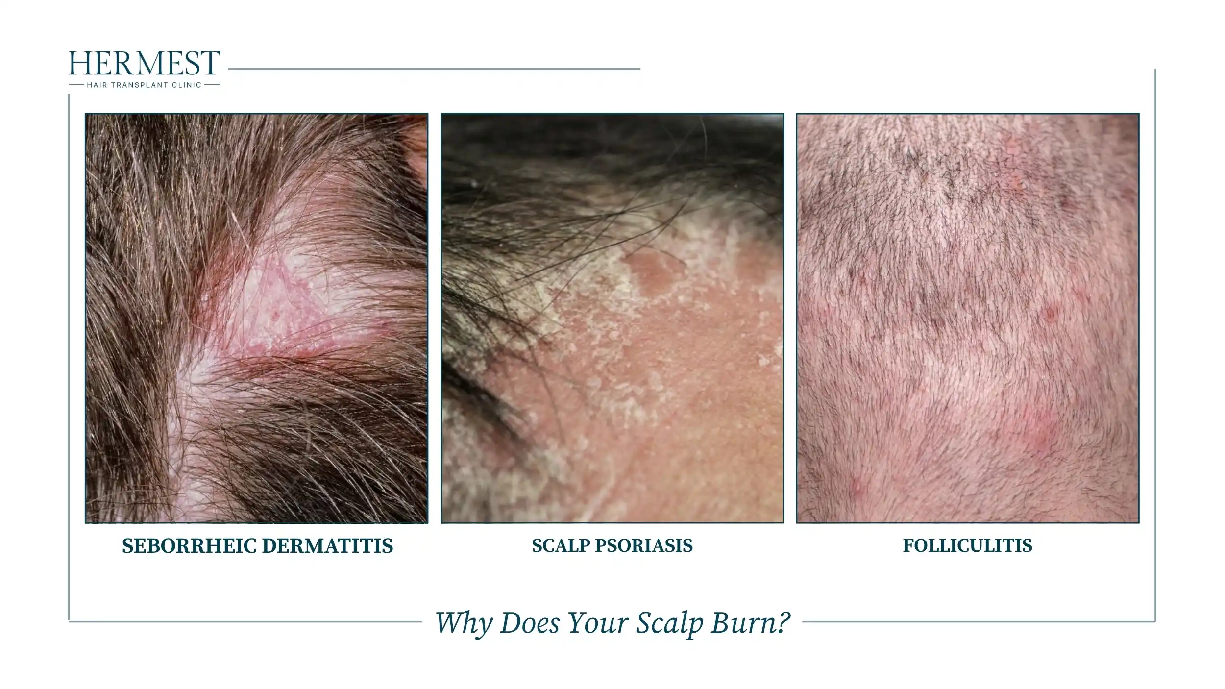 Why Does Your Scalp Burn