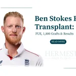 Ben Stokes Hair Transplant