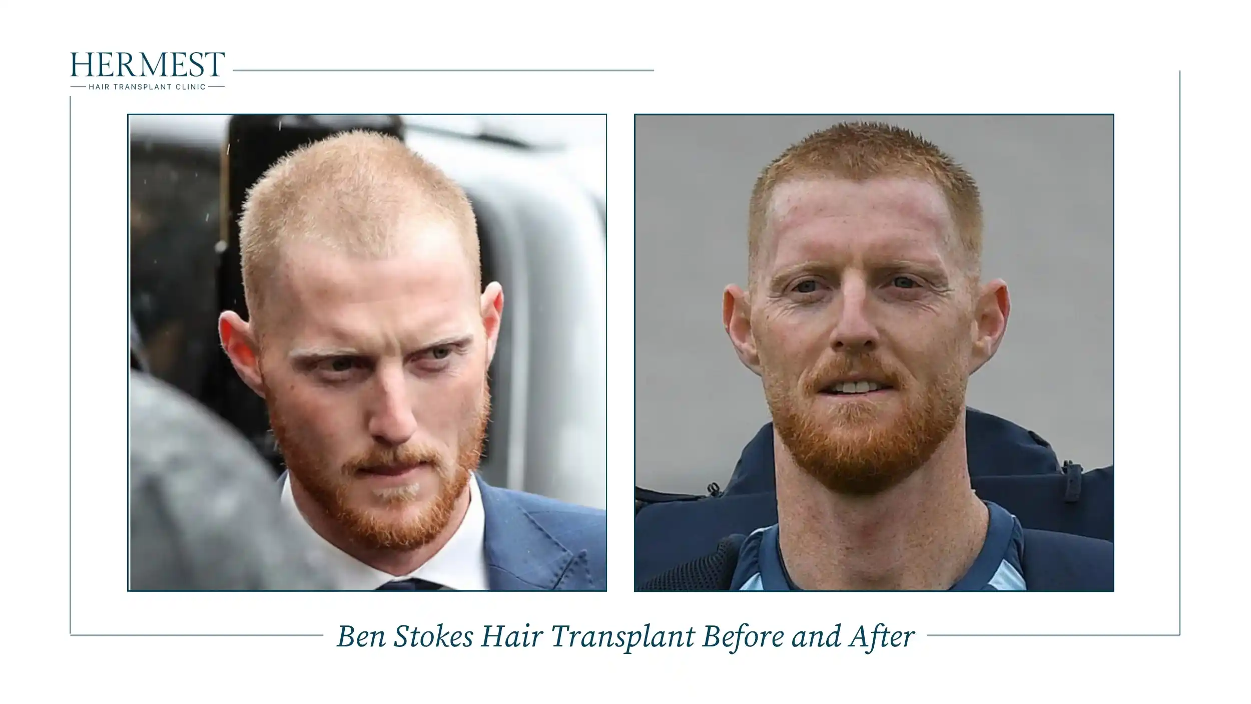 Ben Stokes Hair Transplant Before and After
