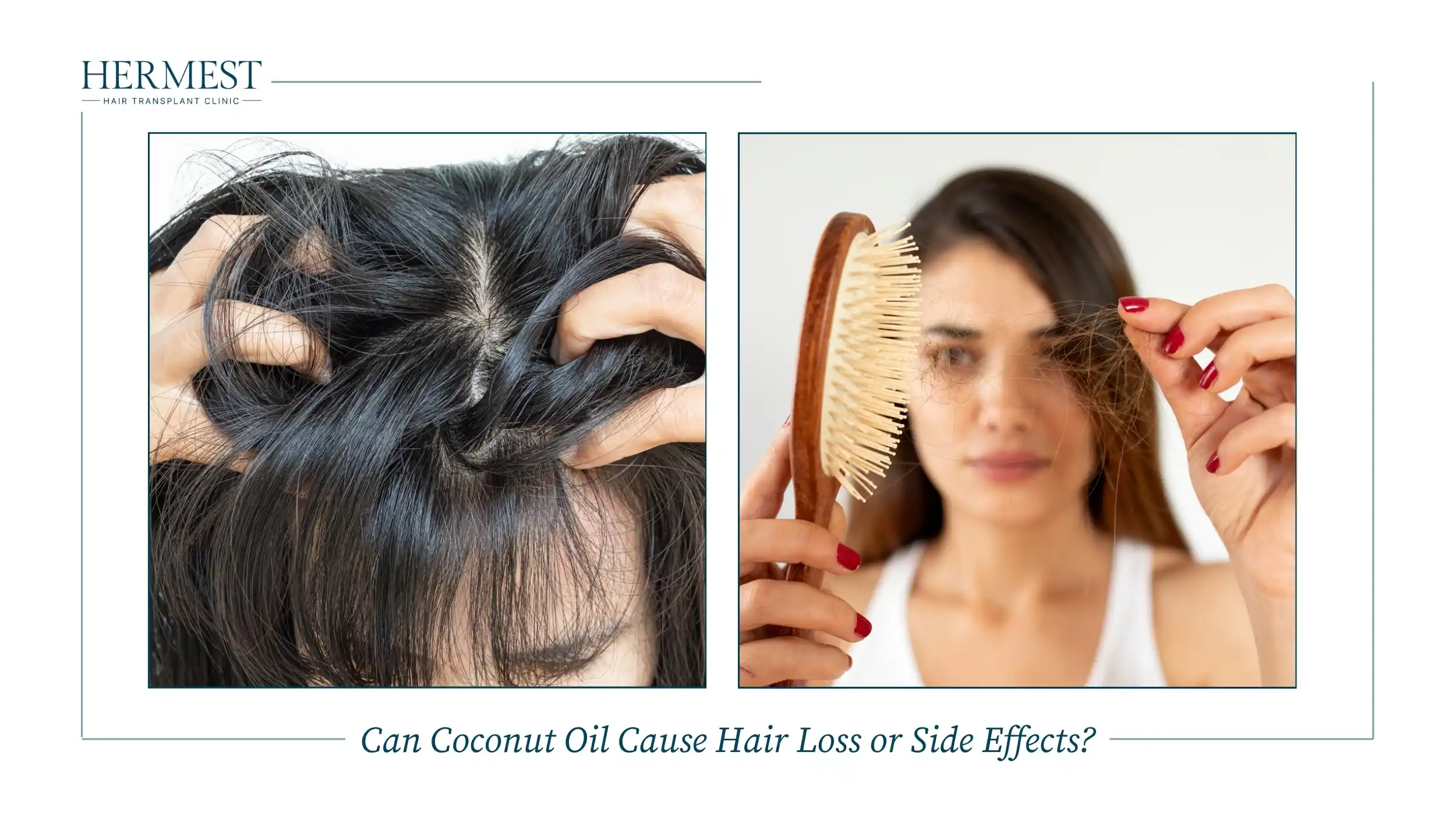 Oily, itchy scalp and a woman with shed hair on her brush, possible side effects of coconut oil