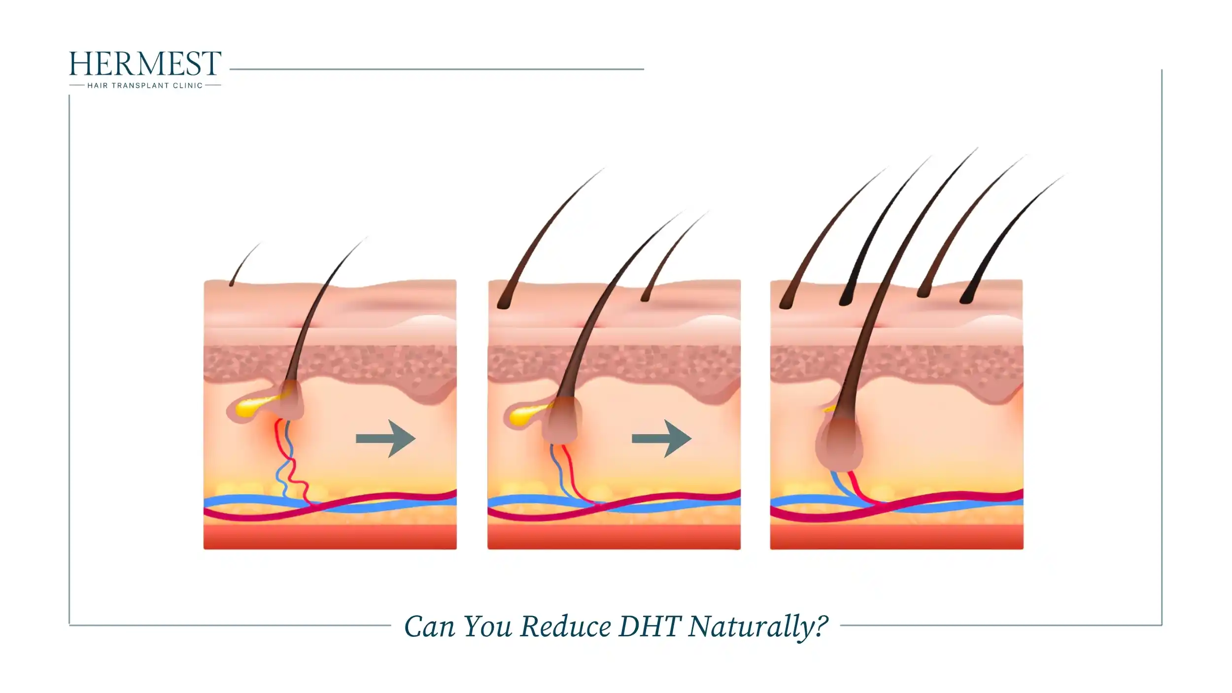 Illustration of hair follicles in the scalp in three stages, from thin miniaturized hairs to thick terminal hairs