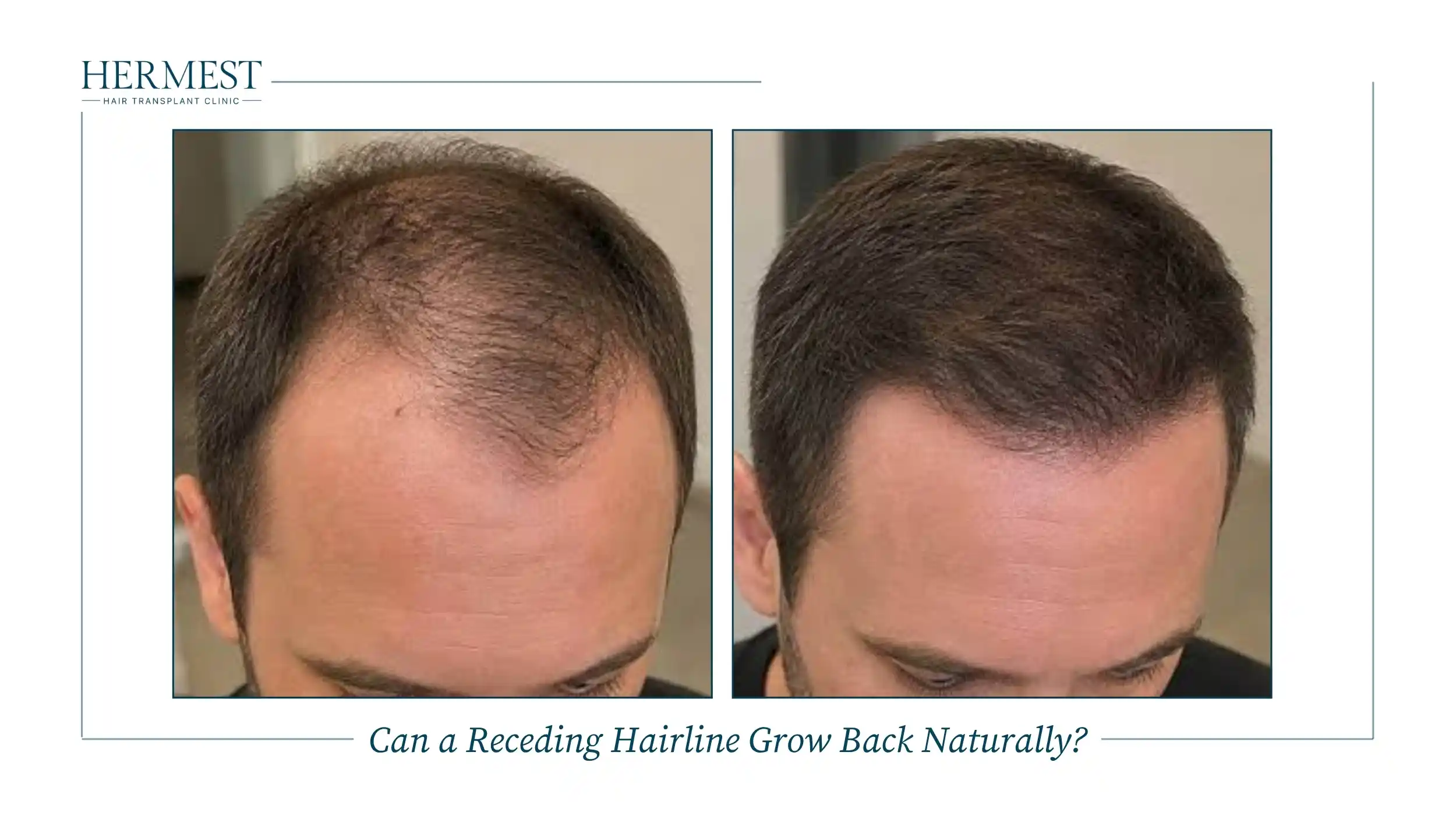 Before and after photos of a man's receding hairline, thin at the temples and front, then fuller and denser