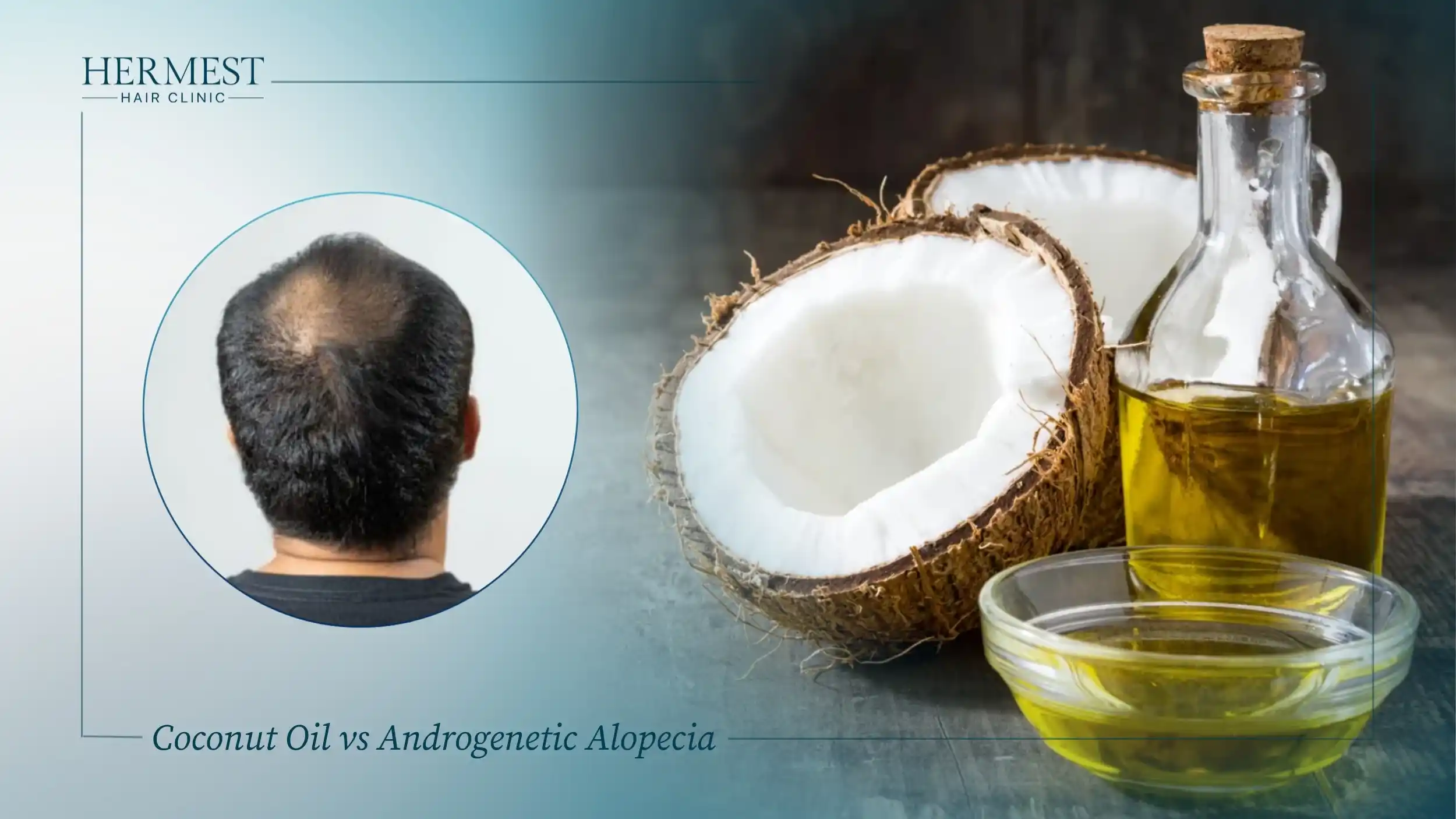 Man with crown balding from androgenetic alopecia beside coconut halves and a bowl of oil