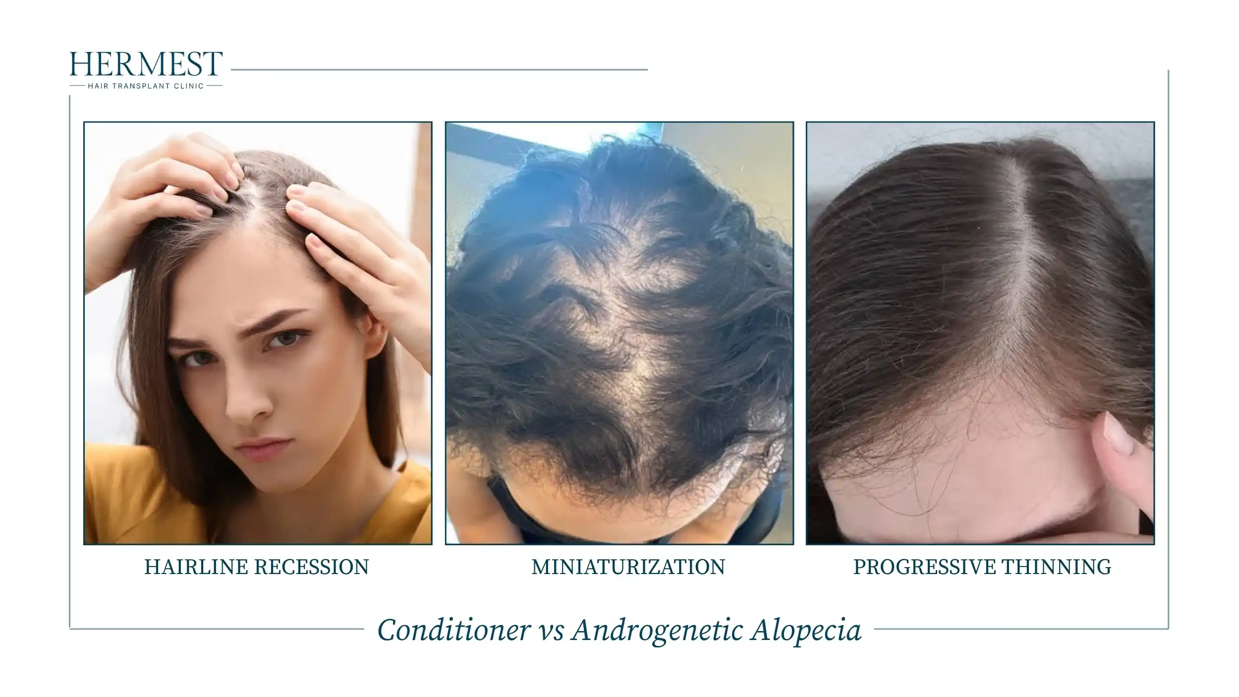 Conditioner vs Androgenetic Alopecia