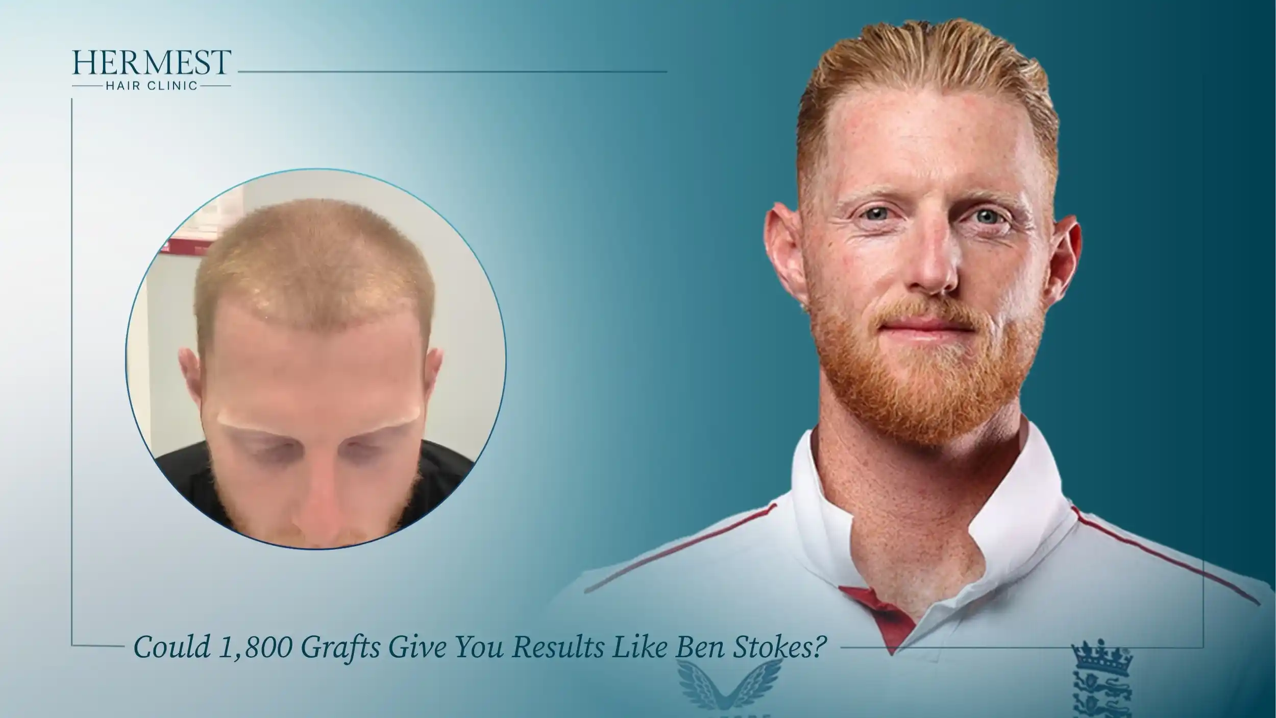 Could 1,800 Grafts Give You Results Like Ben Stokes