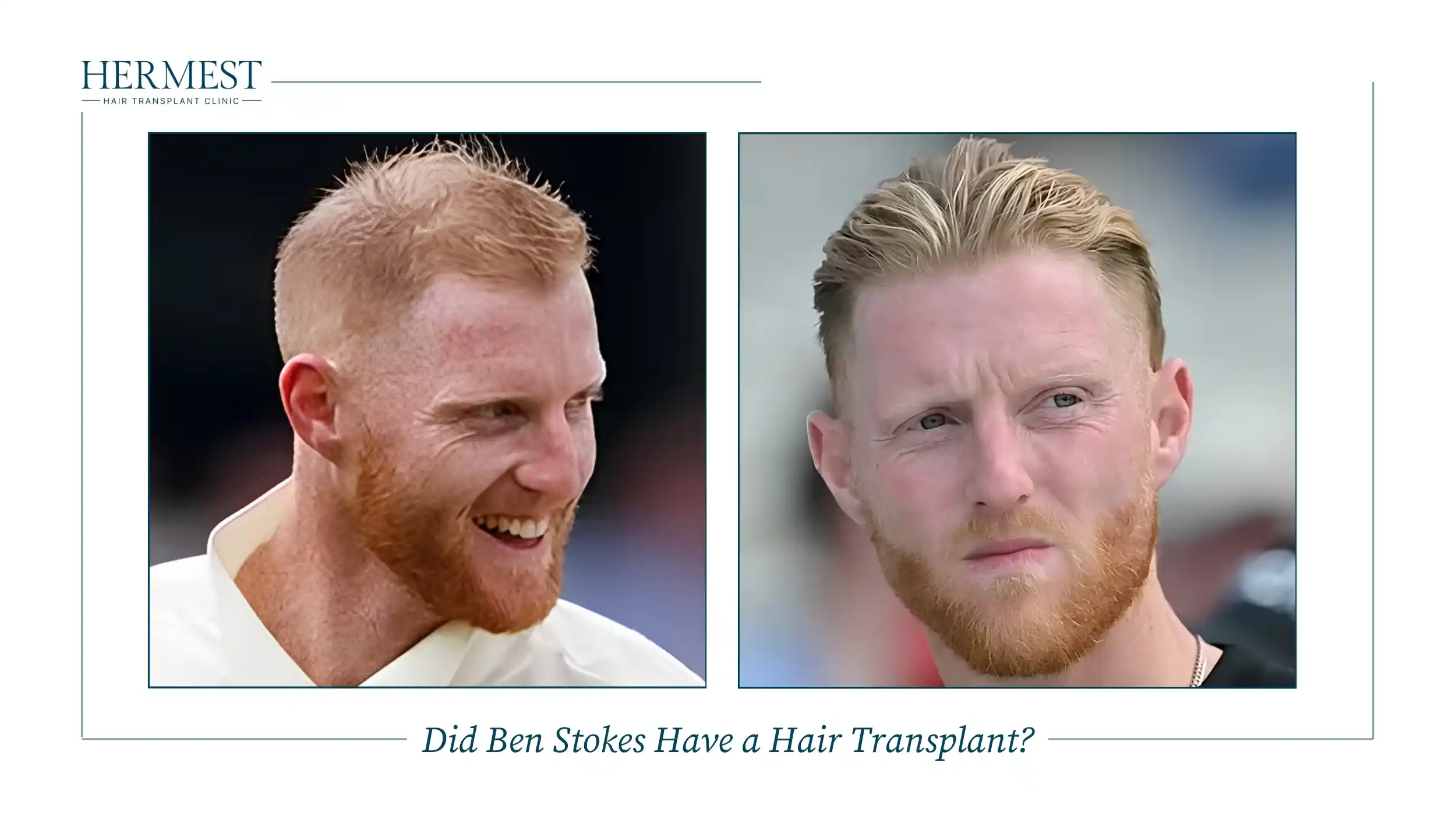 Did Ben Stokes Have a Hair Transplant