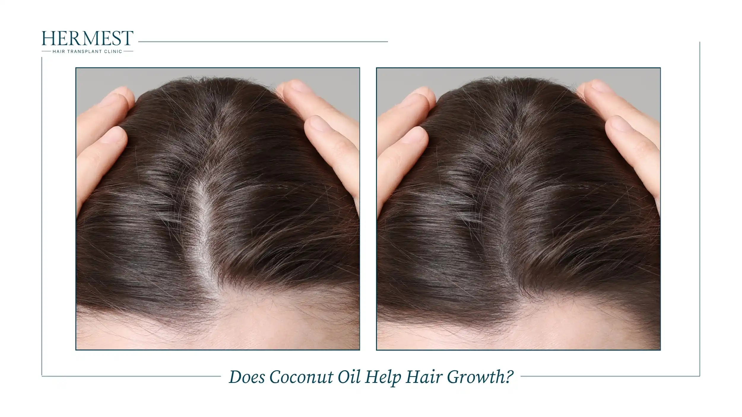 Does Coconut Oil Help Hair Growth