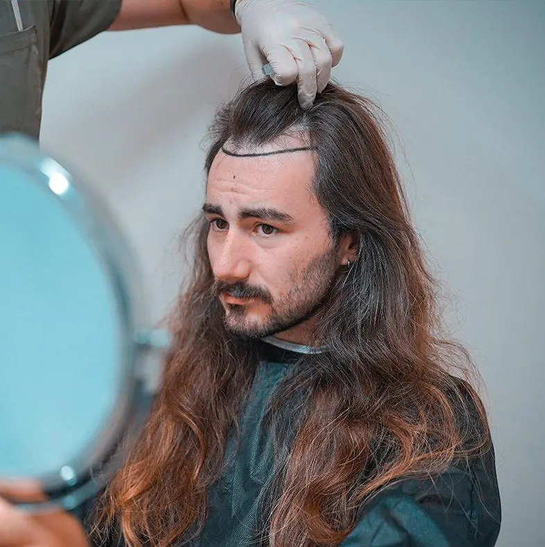 Patient mit langen Haaren und markierter Haarlinie betrachtet sich in einem Handspiegel