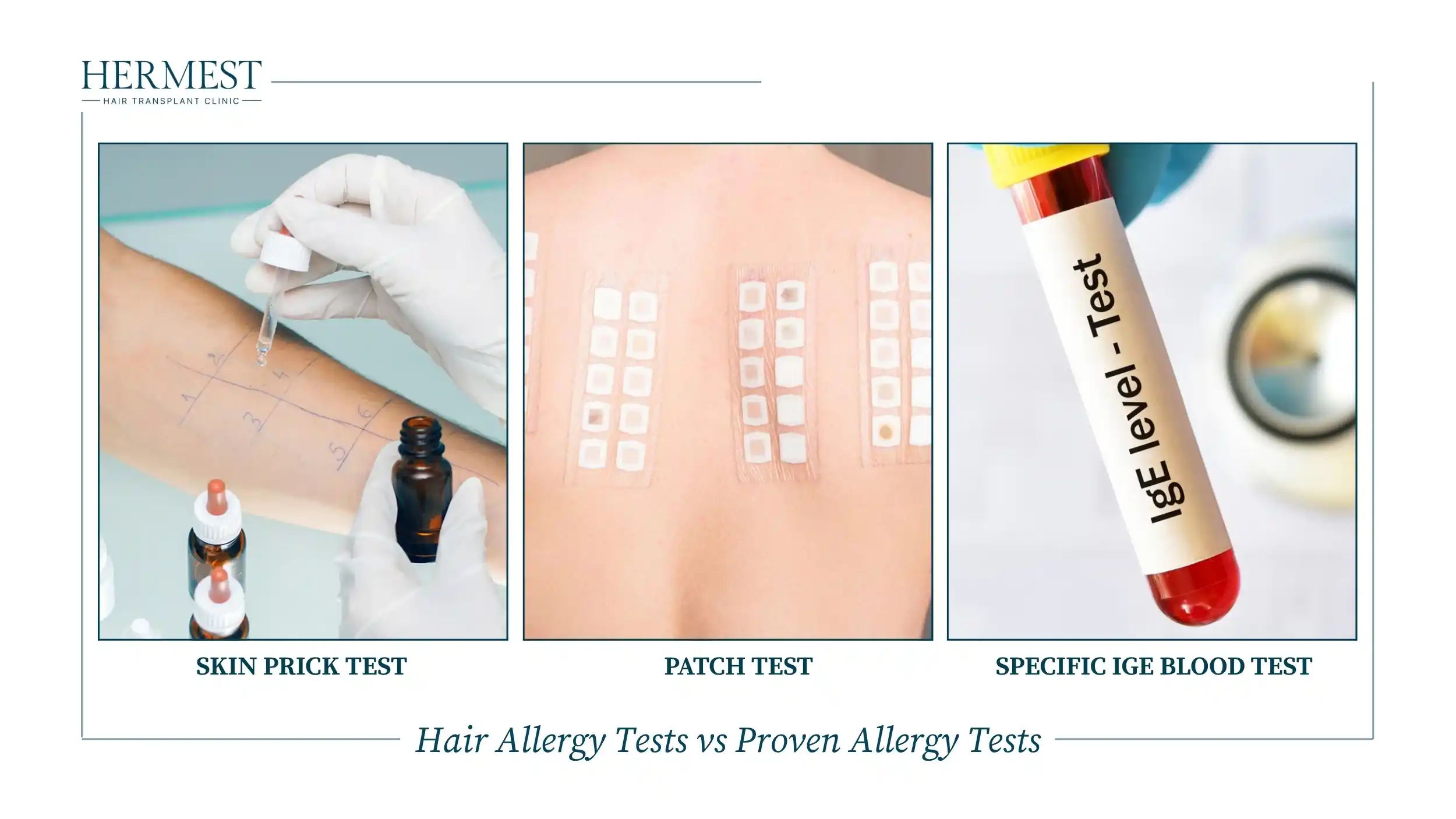Skin prick testing on a forearm, patch-test squares on a back and an IgE blood sample tube