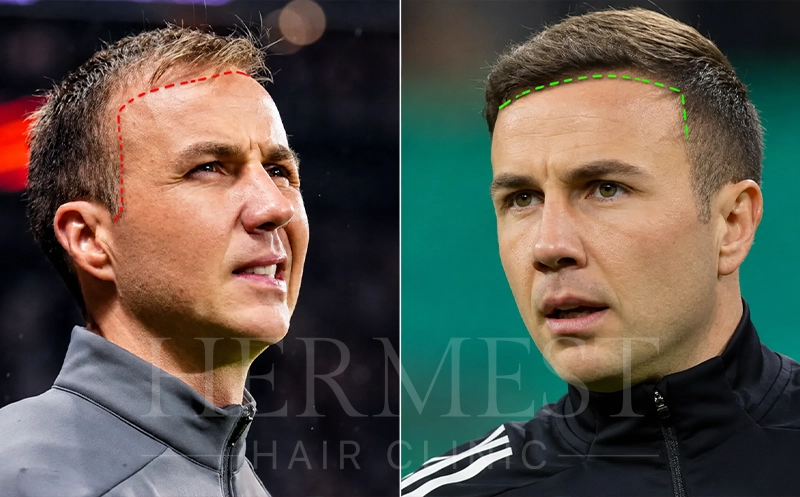 Mario Götze Haartransplantation
