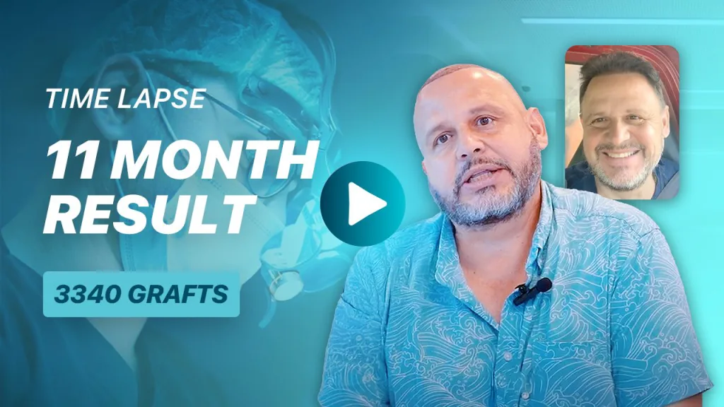 Video: 11-month time-lapse hair transplant result after 3340 grafts