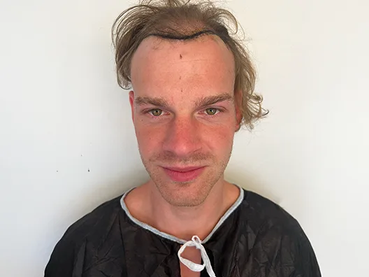 Tecnica DHI, 2700 Innesti — prima del trapianto di capelli