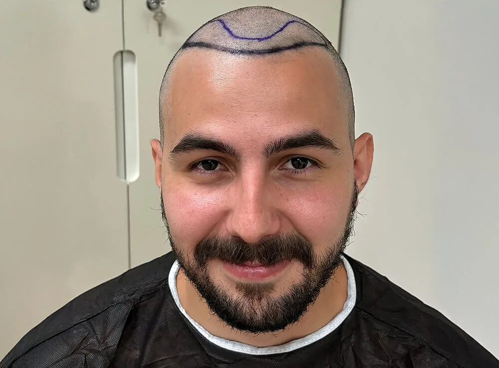 Tecnica DHI, 3500 Innesti — prima del trapianto di capelli