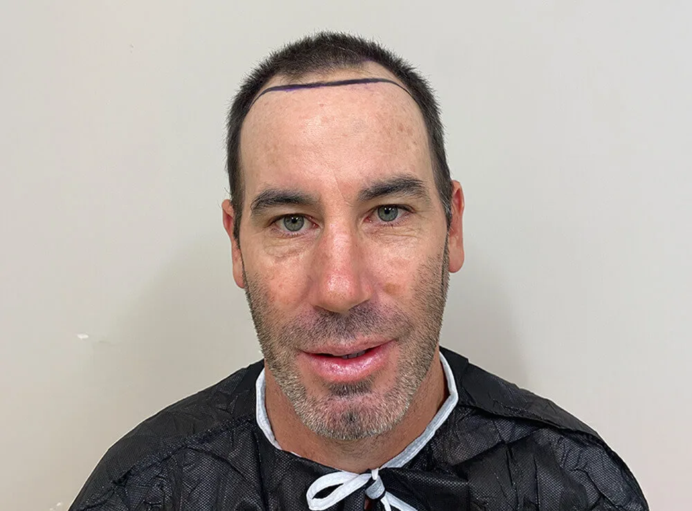 Tecnica FUE, 3800 Innesti — prima del trapianto di capelli