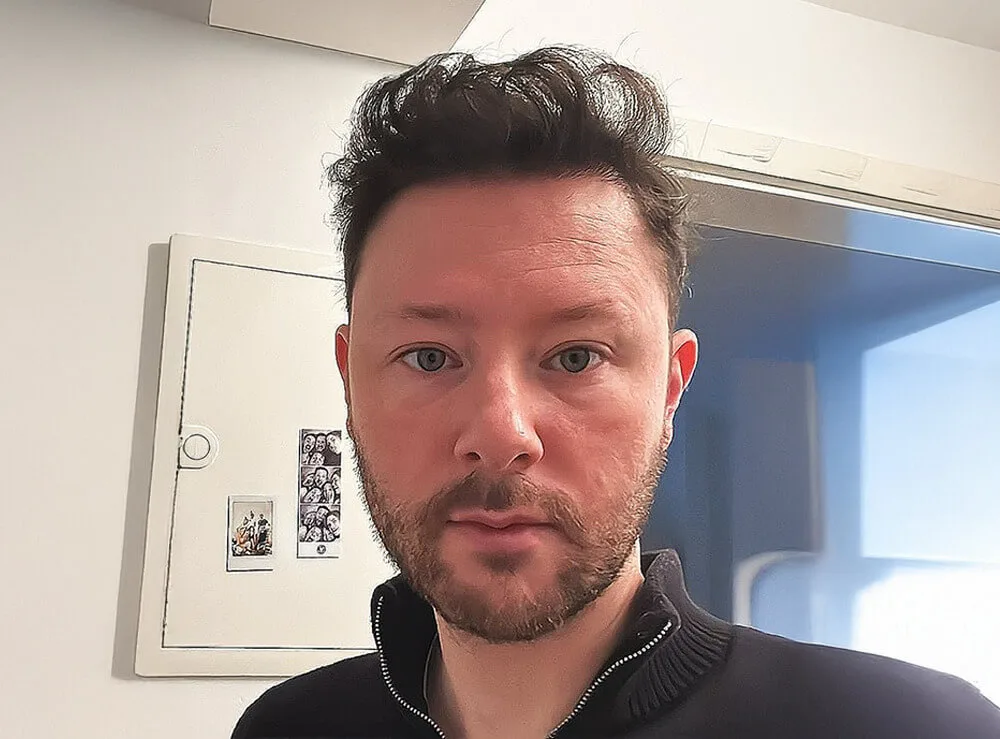 Tecnica DHI, 2700 Innesti — dopo il trapianto di capelli