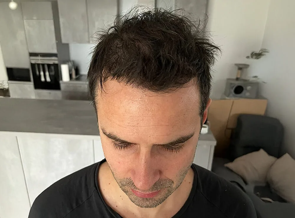 Tecnica Unique FUE, 4100 Innesti — dopo il trapianto di capelli