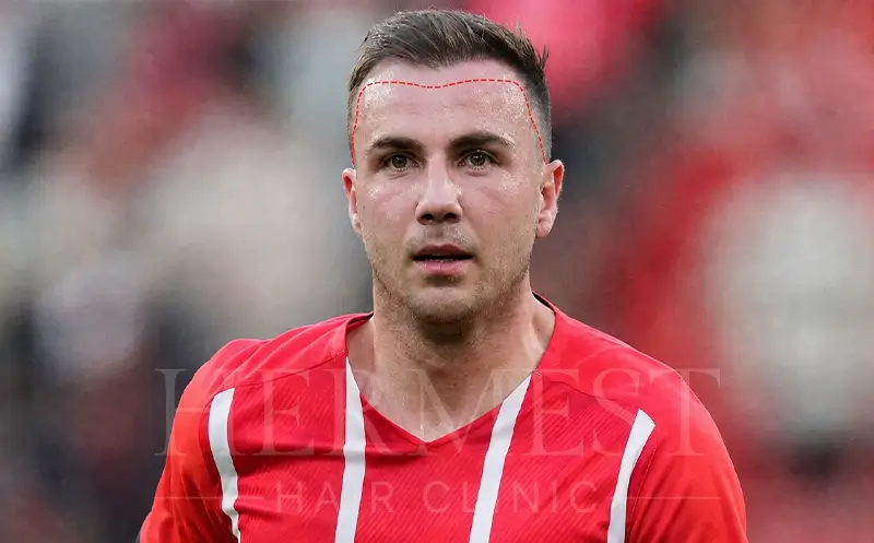 Warum die Frage „Hatte Mario Gotze eine Haartransplantation so viele beschaftigt