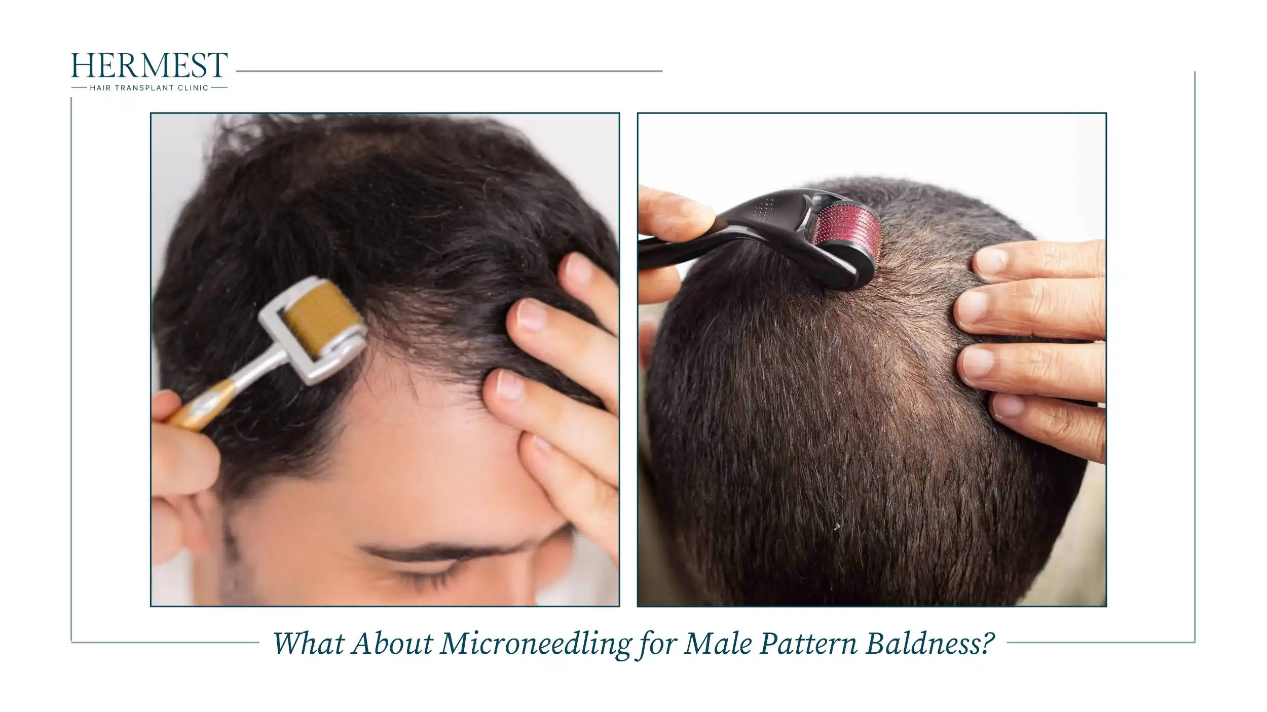 Two men using derma rollers for microneedling, one on a receding hairline and one on the top of the scalp