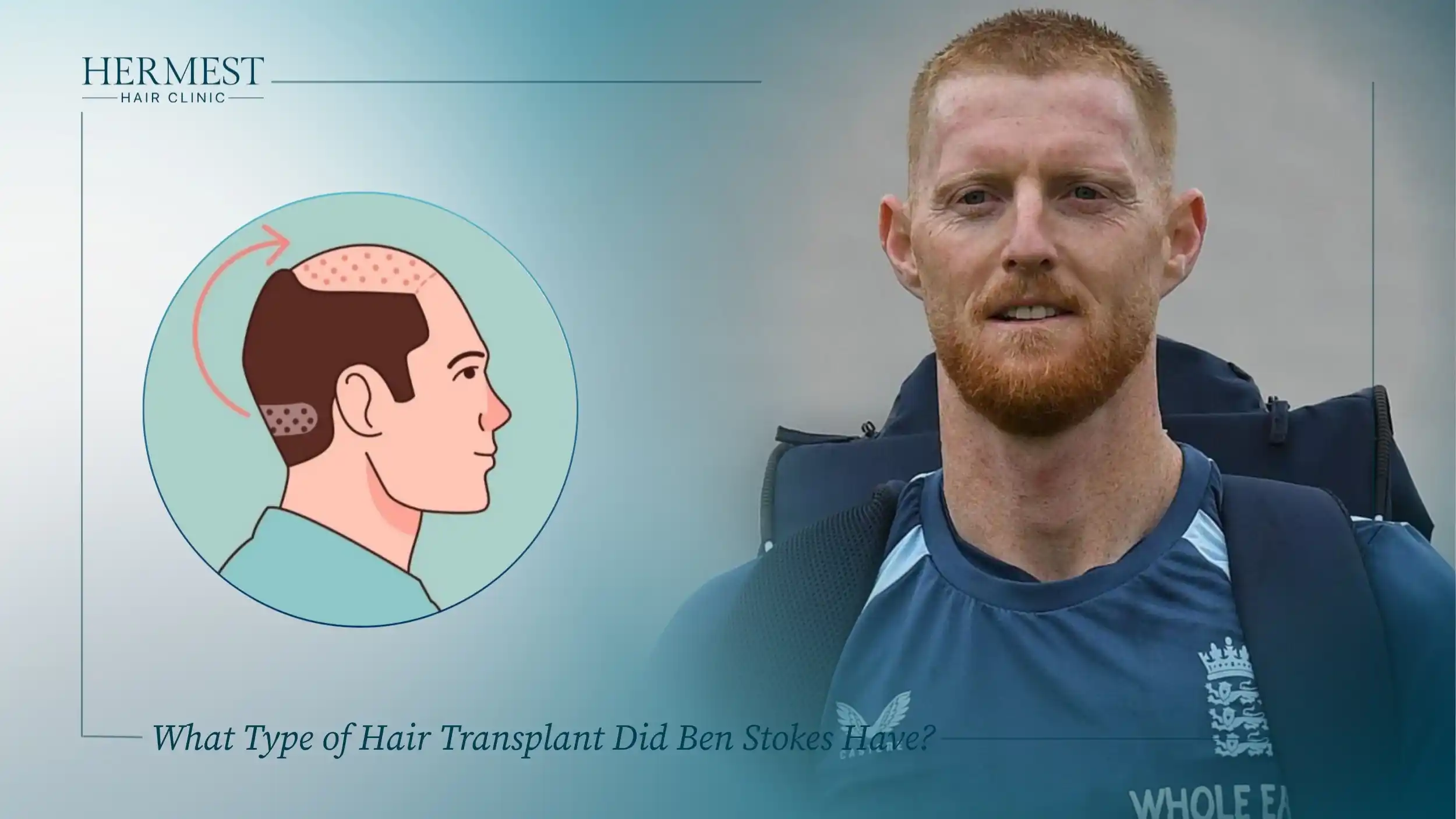 What Type of Hair Transplant Did Ben Stokes Have