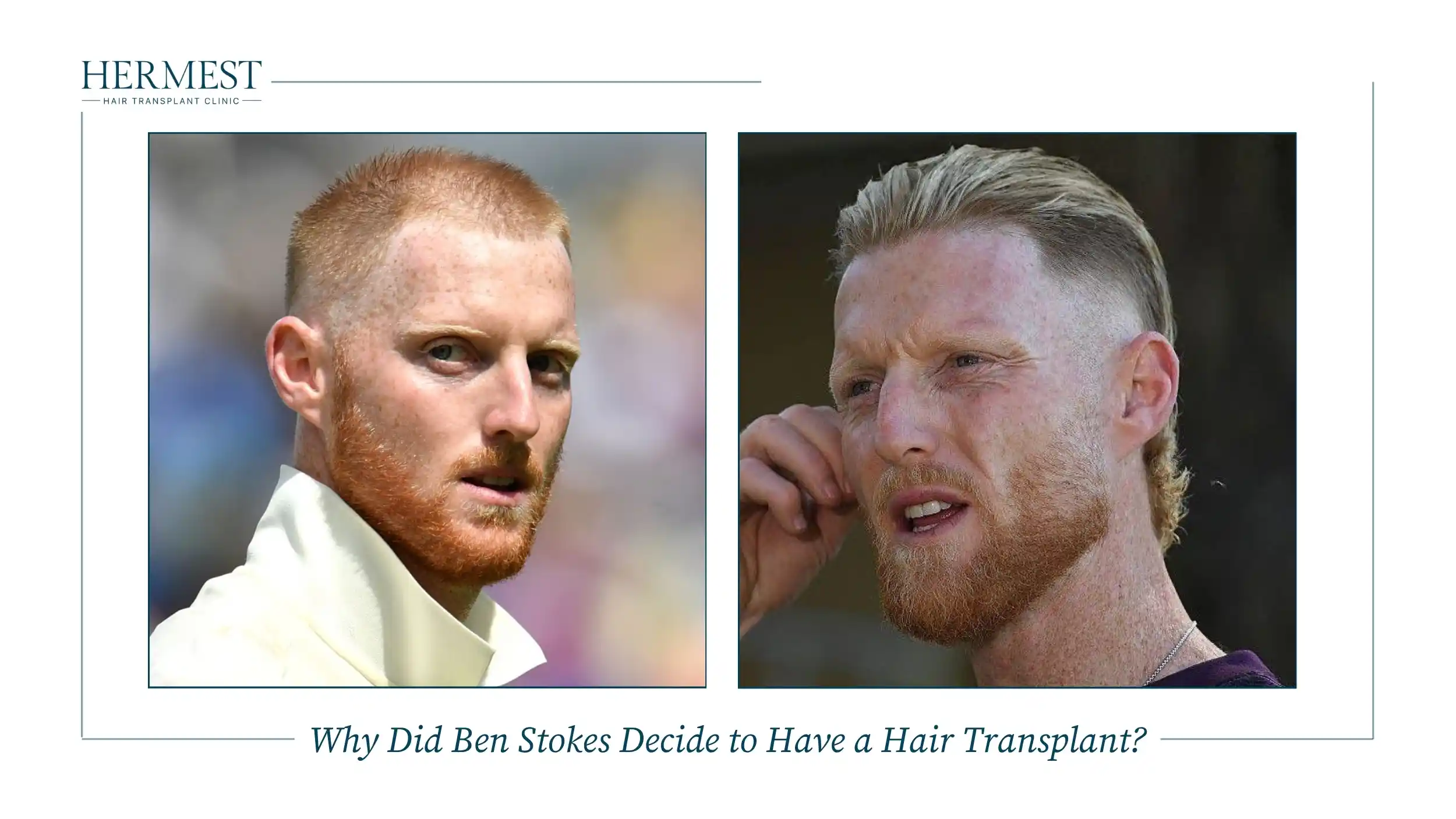 Why Did Ben Stokes Decide to Have a Hair Transplant