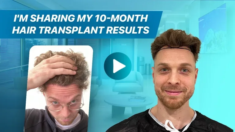 Matthew — videotestimonianza sul trapianto di capelli Hermest
