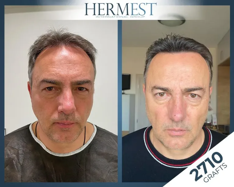 Saç ekimi öncesi sonrası – 2710 greft