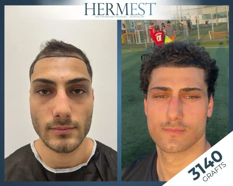 Saç ekimi öncesi sonrası – 3140 greft