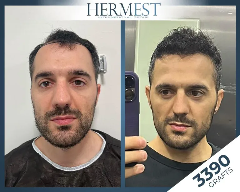Saç ekimi öncesi sonrası – 3390 greft