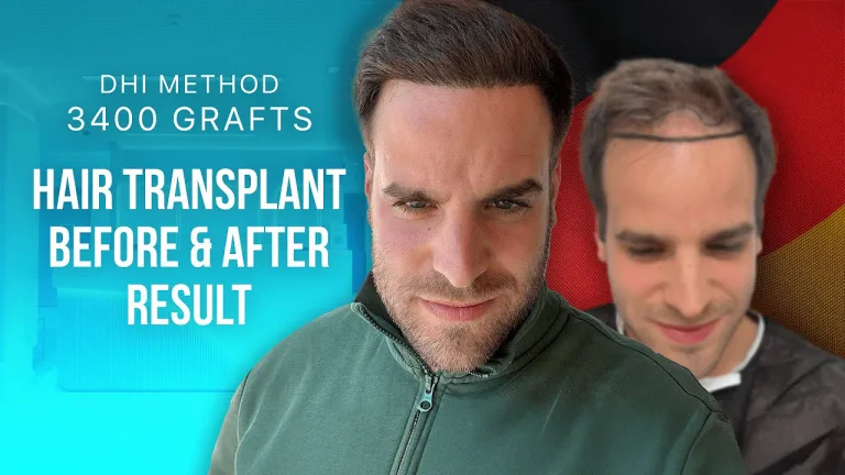 Giuseppe — Hermest Haartransplantation Patientenbewertung
