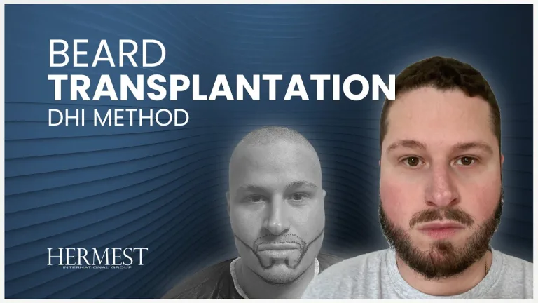 Alexis — Hermest Haartransplantation Patientenbewertung