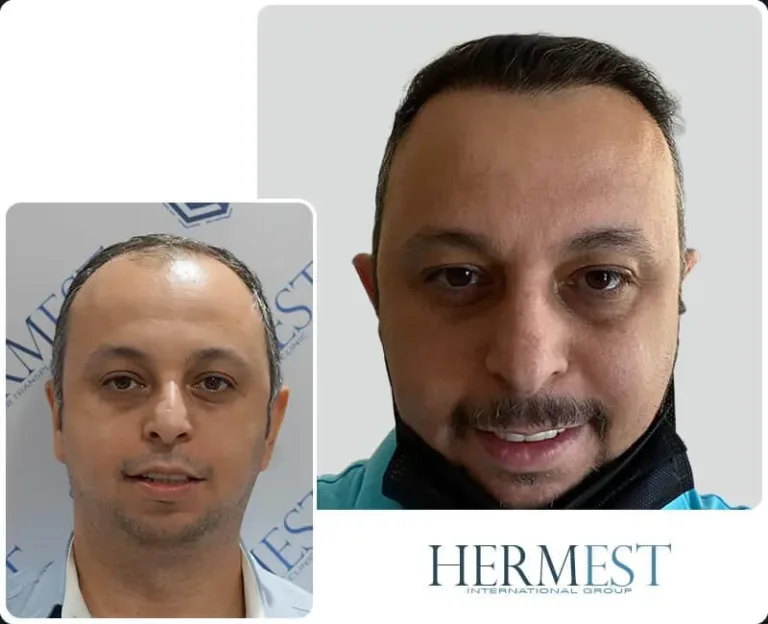 Hair Transplant Gallery